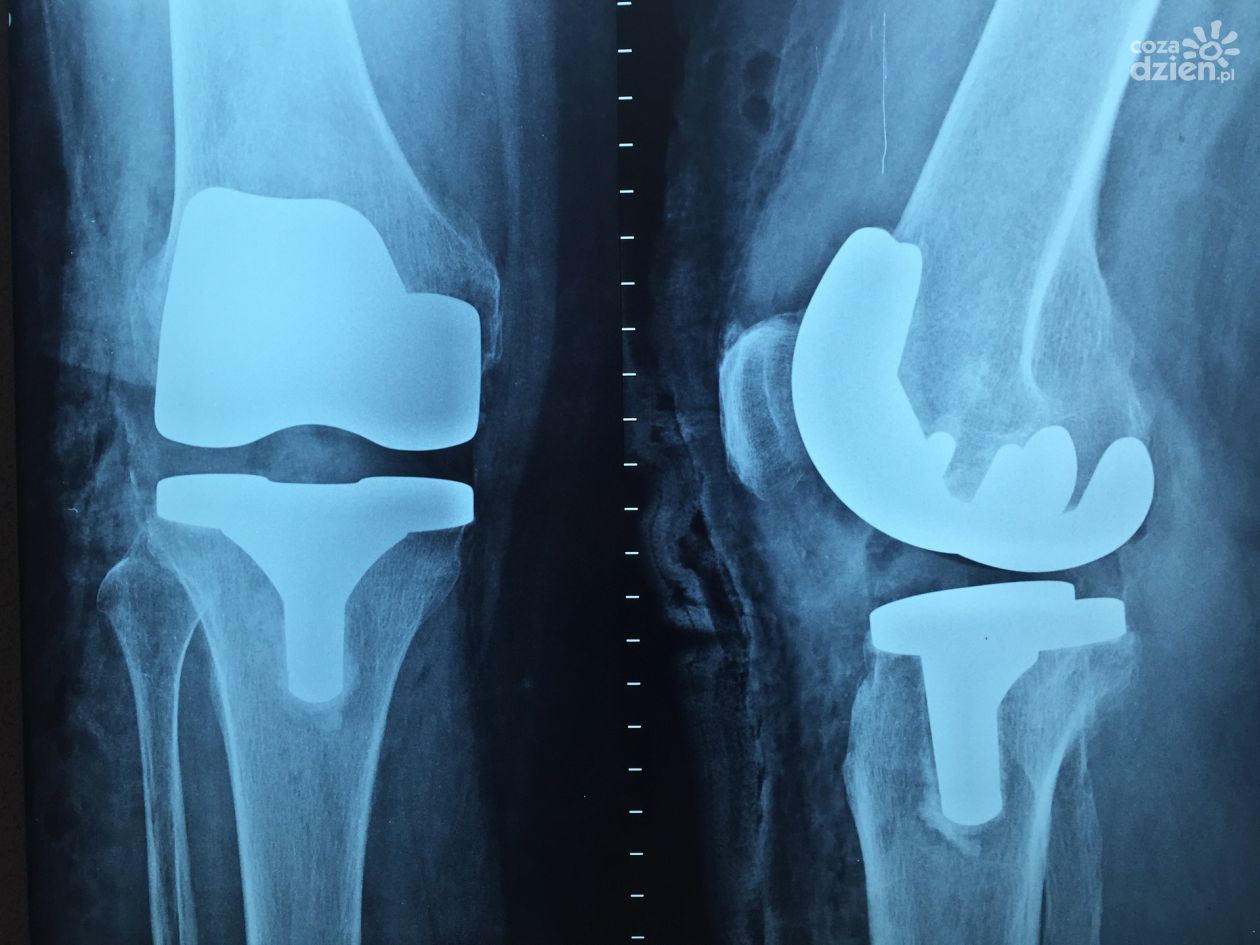 Coraz więcej pacjentów z urazami ortopedycznymi