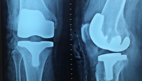 Coraz więcej pacjentów z urazami ortopedycznymi