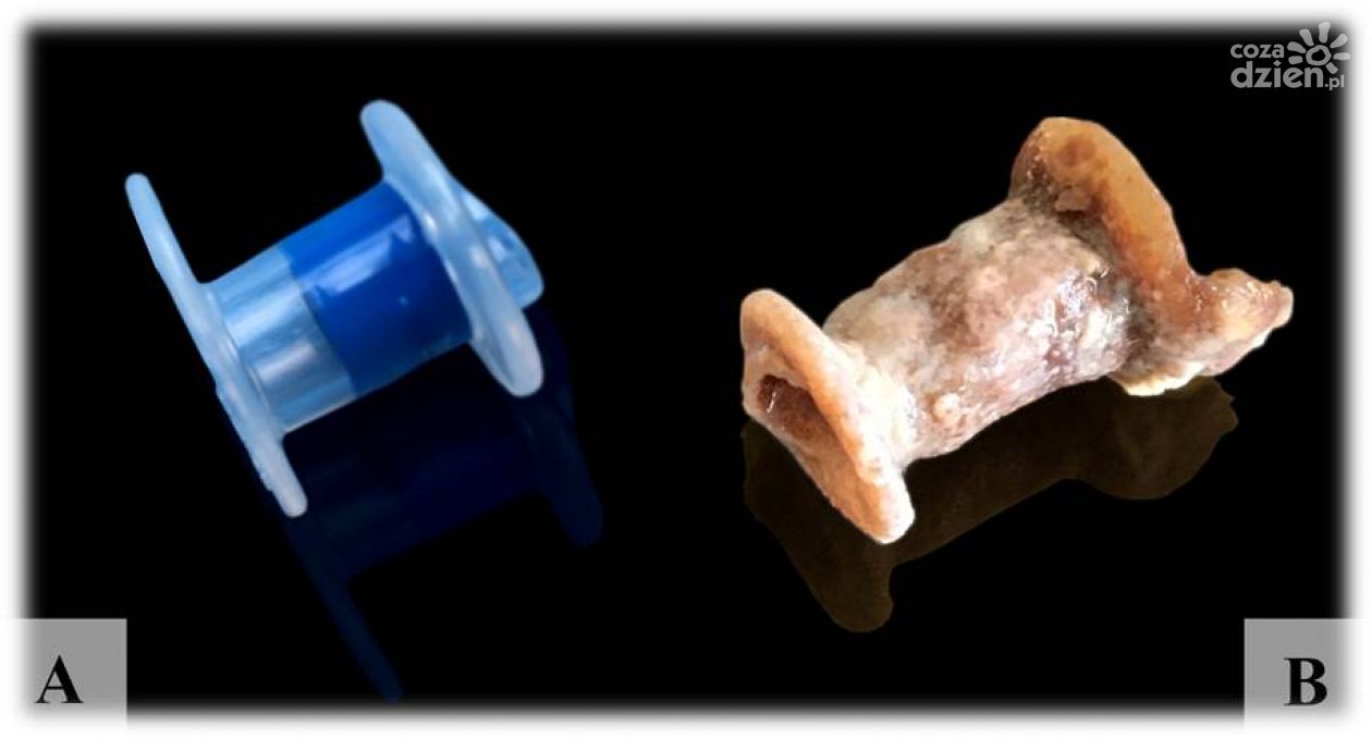 W ŚCO wynaleziono metodę zabezpieczania protez krtani 