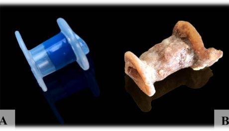 W ŚCO wynaleziono metodę zabezpieczania protez krtani 